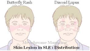 Discoid Lupus Rash Pictures