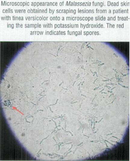 Tinea Versicolor (Fungal Infection) - StoryMD