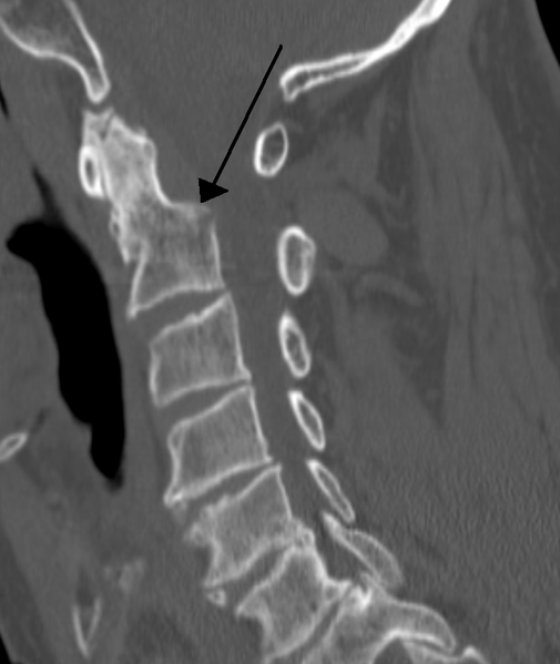 File:Odontoid process fracture CT.png