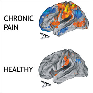 Body Mind or Mind Body Connection? — Resolving Chronic Pain