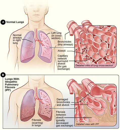 File:Normal lungs.jpg