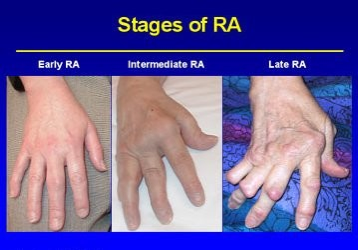 File:RA stages.png