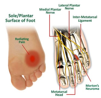 What Is Morton's Toe And What To Do About It - Tread Labs