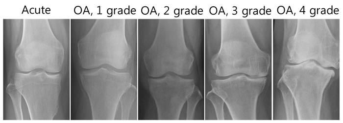File:Stages Knee Osteoartritis.jpg