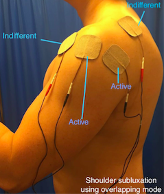 File:Shoulder subluxation using overlapping mode Picture.png