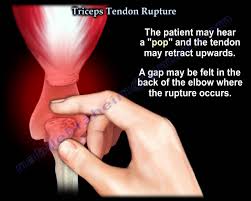 Rupture of the Triceps Brachii muscle - Physiopedia