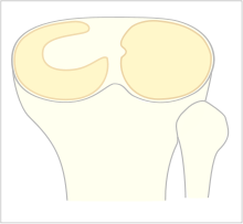 File:Discoid-meniscus.png