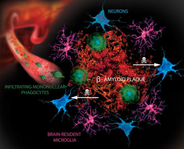 File:Mononuclear phagocytes in Alzheimer’s disease.jpg