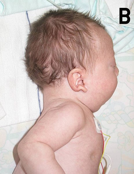File:Noonan Syndrome Infant.jpg
