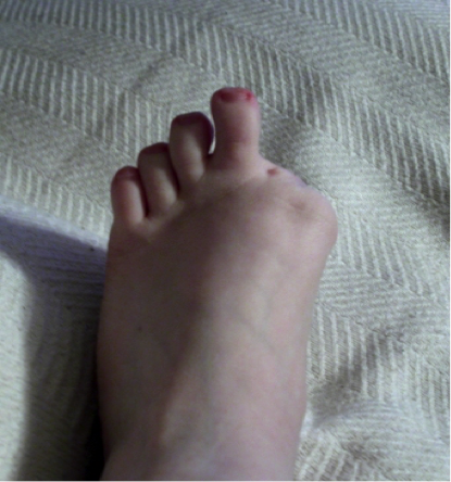 File:Amputations-foot-3.png