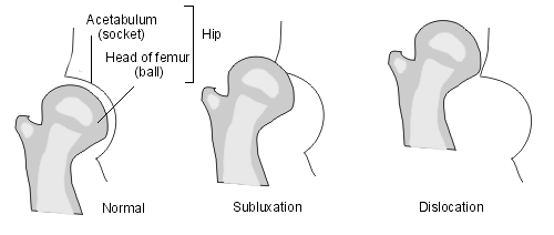 Hip dislocation1.png