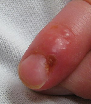 blood blister on finger nail cuticle