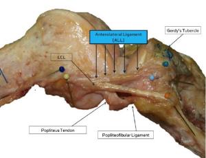Anterolateral Ligament of the Knee - Physiopedia