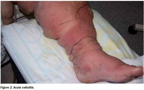 File:Cellulitis and lymphedema.JPG