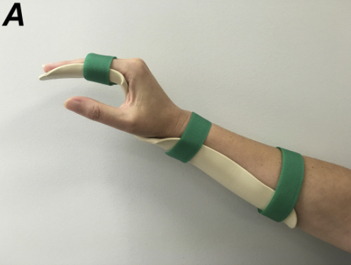 File:Resting hand orthosis.png
