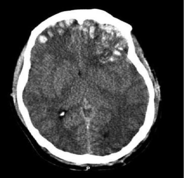 File:PP-Brain trauma CT.jpg