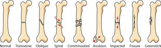 different types of bone fracture