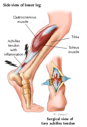 achilles tendon pain and swelling