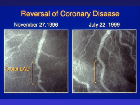 File:Coronary Artery Disease diet.jpg