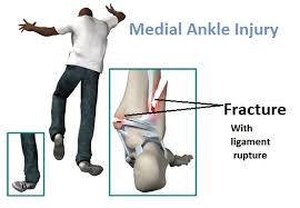 Sports Injury Bulletin - Diagnose & Treat - Deltoid ligament: Not