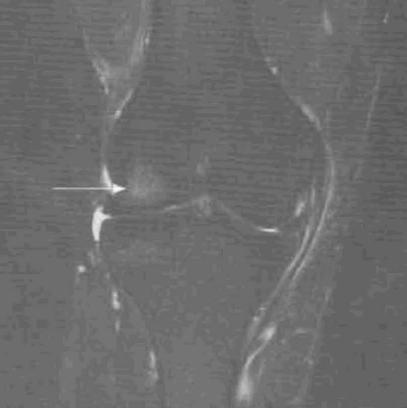 File:Bone bruise MRI.PNG
