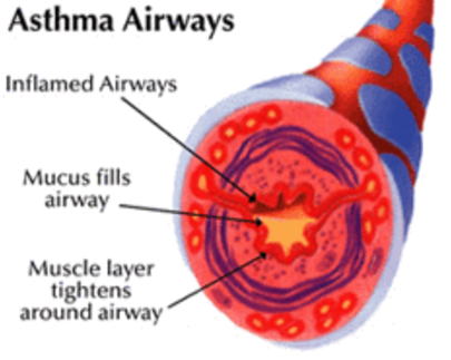 File:Asthma airways.png