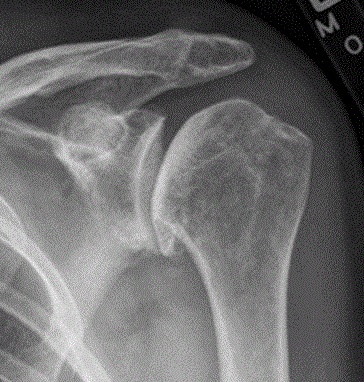 File:X-ray of osteoarthritis of the shoulder.jpg