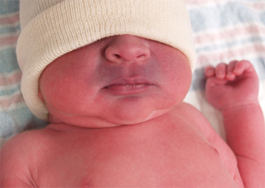 Infant with cyanosis of the lips