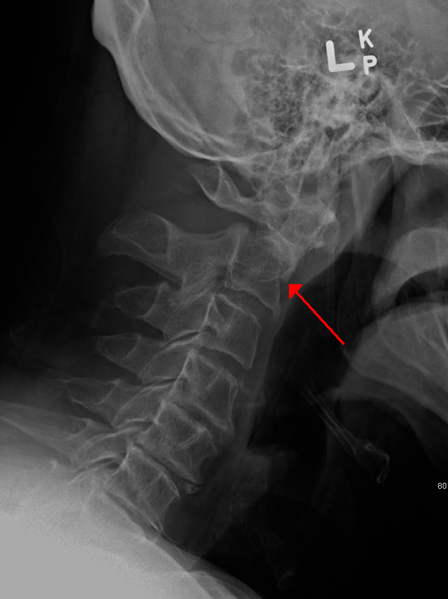 File:Odontoid process fracture xray.png