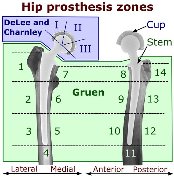 File:Hip prosthesis zones by DeLee and Charnley system, and Gruen system.jpg