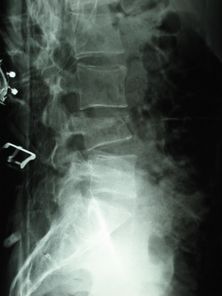 Plain radiographs of the dorso-lumbar spine after the onset of