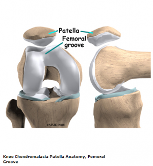 physiopedia chondromalacia patellae patella grades meniscus chondropathie femoral