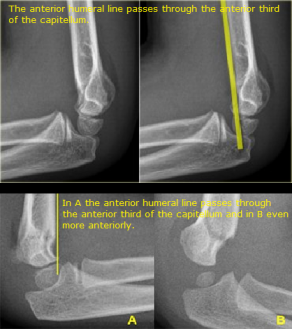 Anterior humeral line abnormal.png