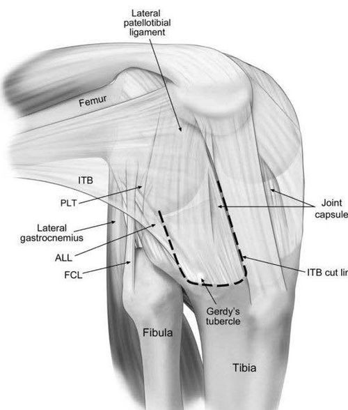 Anterolateraal aanzicht van een rechterknie - Iliotibiale band (ITB), anterolateraal ligament (ALL), FCL, collateraal fibulair ligament; PLT, popliteuspees.