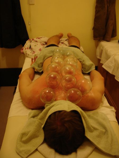 File:Fire Cupping 2008.jpg