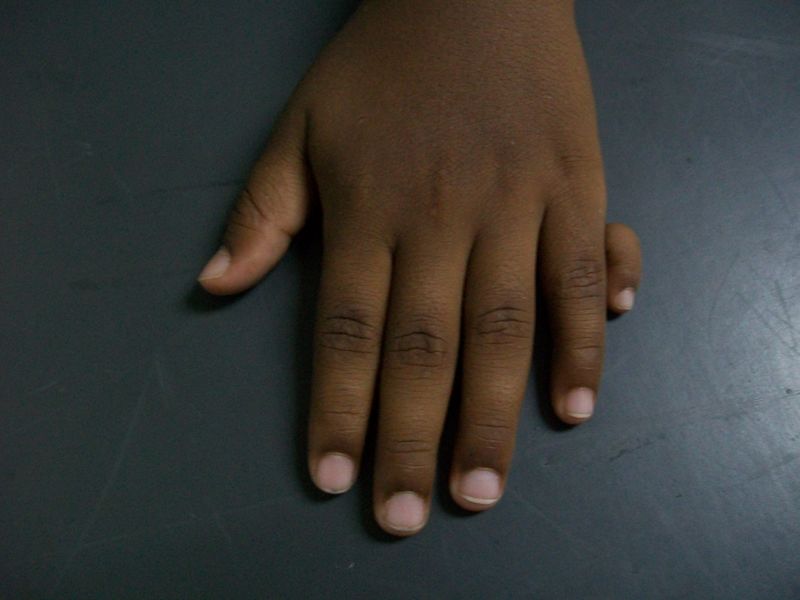 File:Polydactyly Left Hand.jpg
