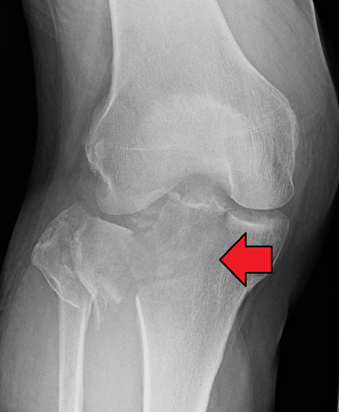 File:Tibial Plateau Fracture .png