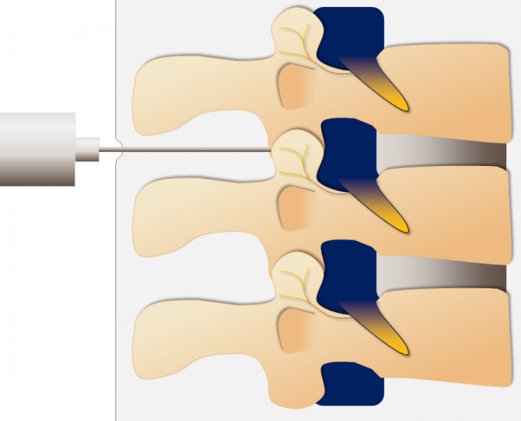 File:Facet Joint Injection Diagram.png