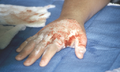 Petechiae on back of hand. Photo used with kind permission from Diane Merwarth PT