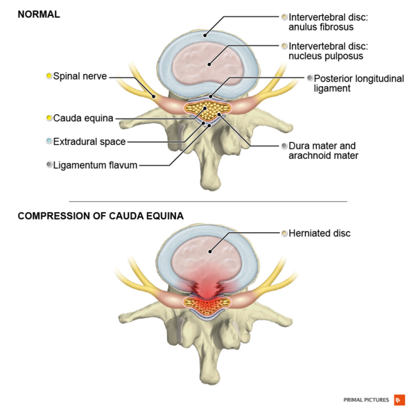 File:Cauda equina syndrome Primal.png