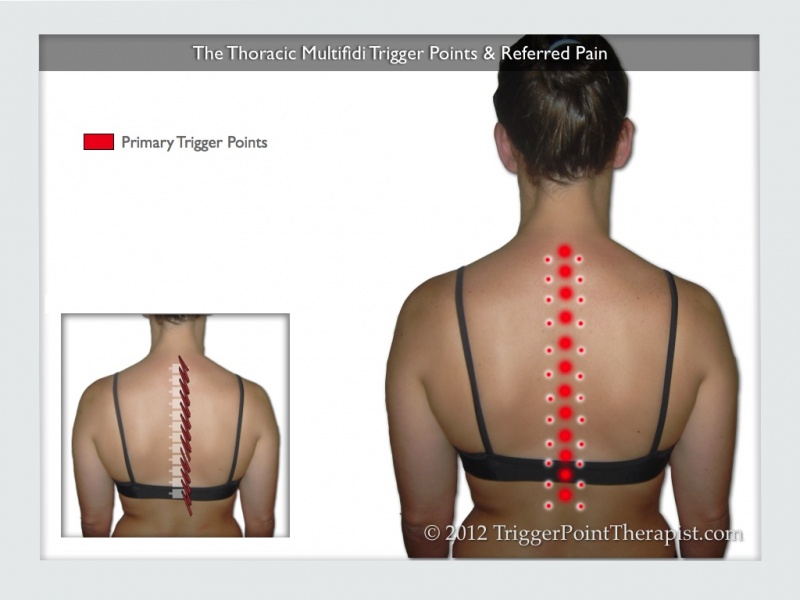 File:Thoracic multifidus trigger points referred pain.jpg
