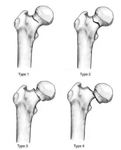 Femoral Neck Fractures, Garden Classification - Physiopedia
