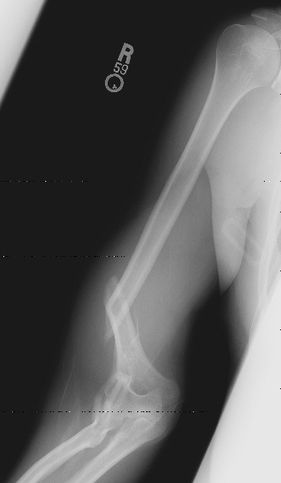 Fracture - Physiopedia
