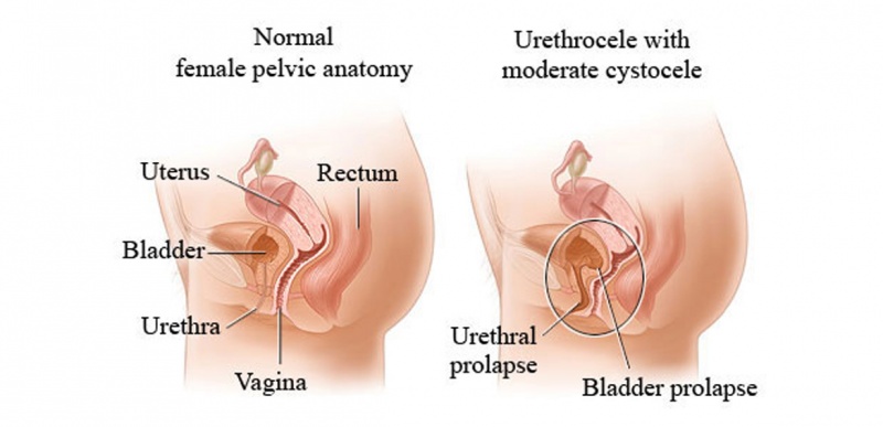 File:Urethrocele Prolapse.jpg