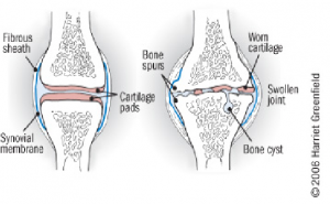 osteoarthritis knee swelling