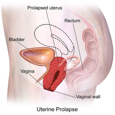Prolapsed bladders are usually - Manipal Hospitals