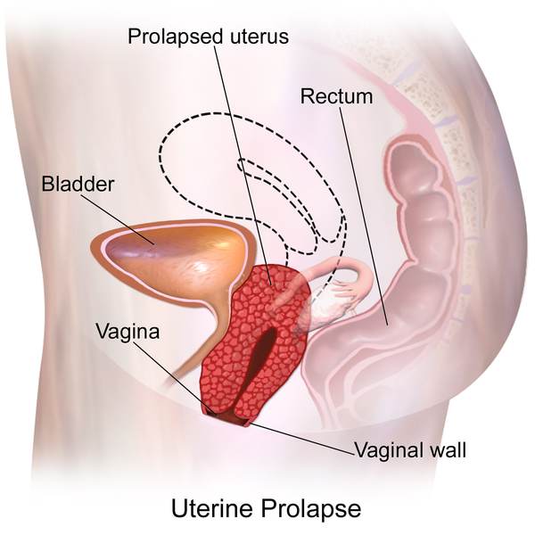 File:Uterine Prolapse diagram.png