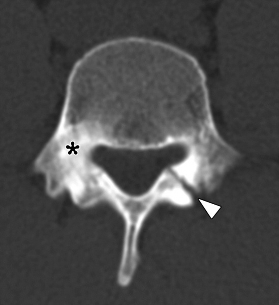 File:Spondylolysis CT scan (1).docx.jpg