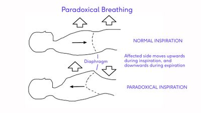 paradoxical breathing