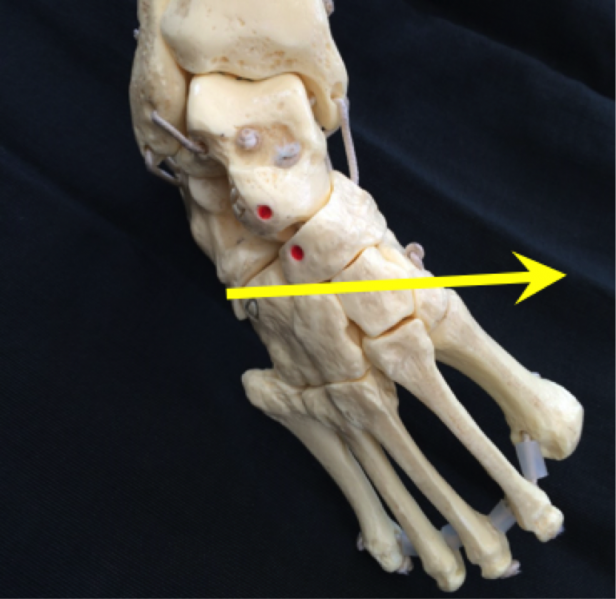 File:Clubfoot - 7.png
